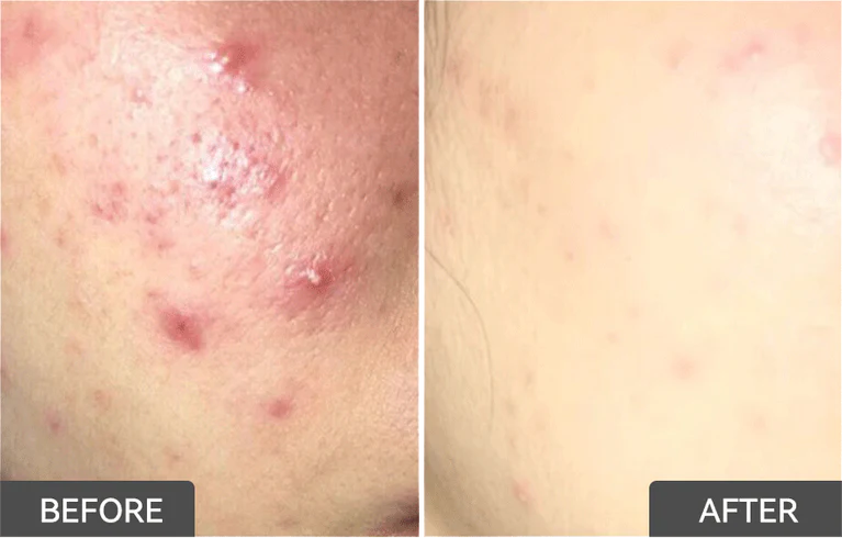 Emergency Acne Control for Sudden Breakouts