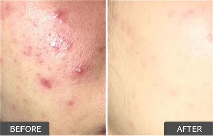 Emergency Acne Control for Sudden Breakouts