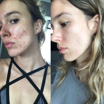 Emergency Acne Control for Sudden Breakouts