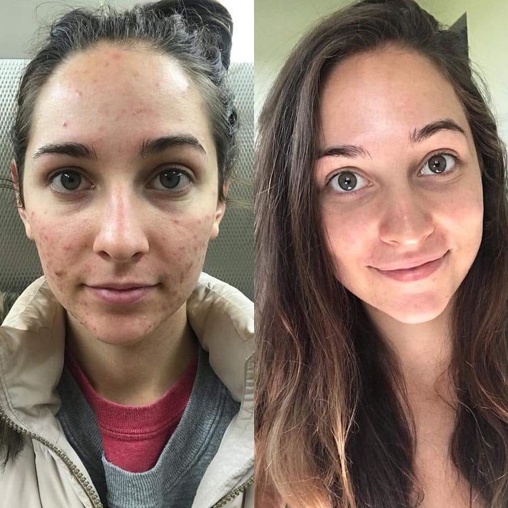 Emergency Acne Control for Sudden Breakouts